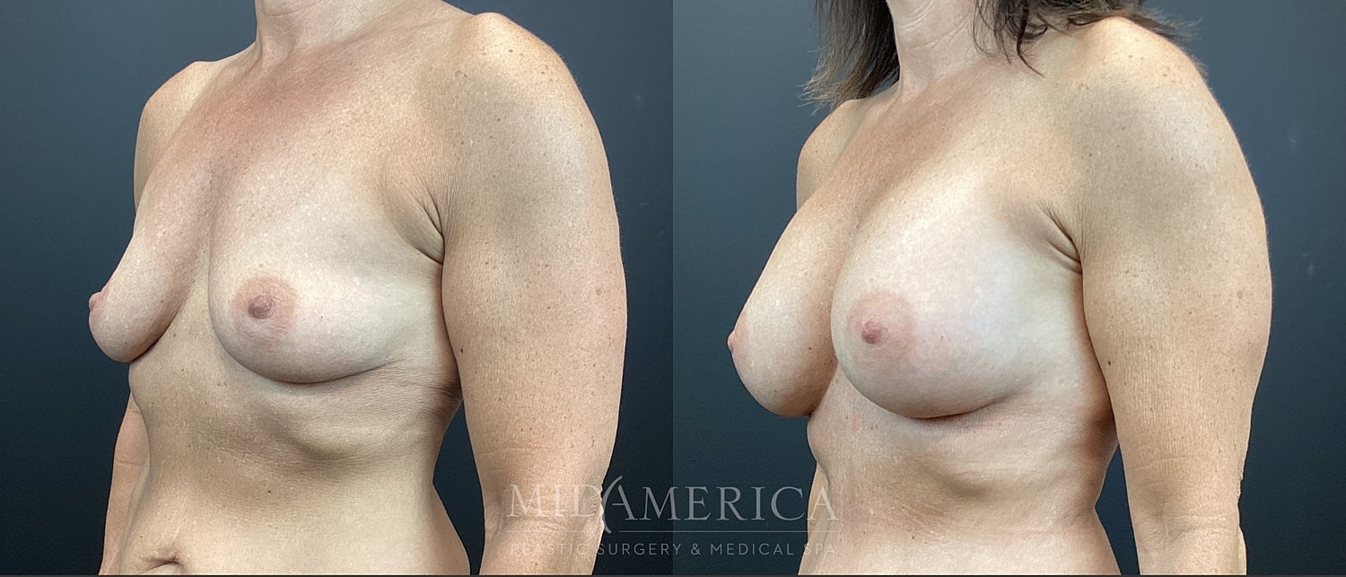 Breast Augmentation Before & After