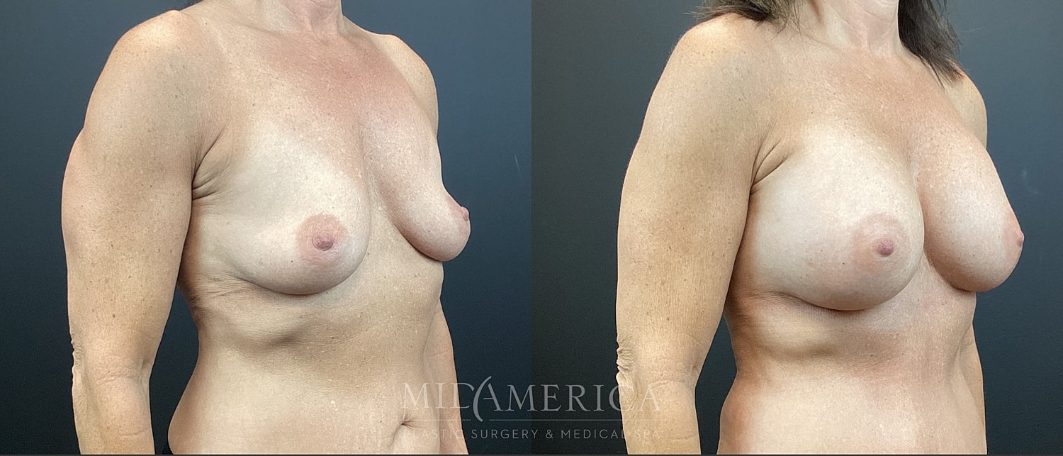 Breast Augmentation Before & After