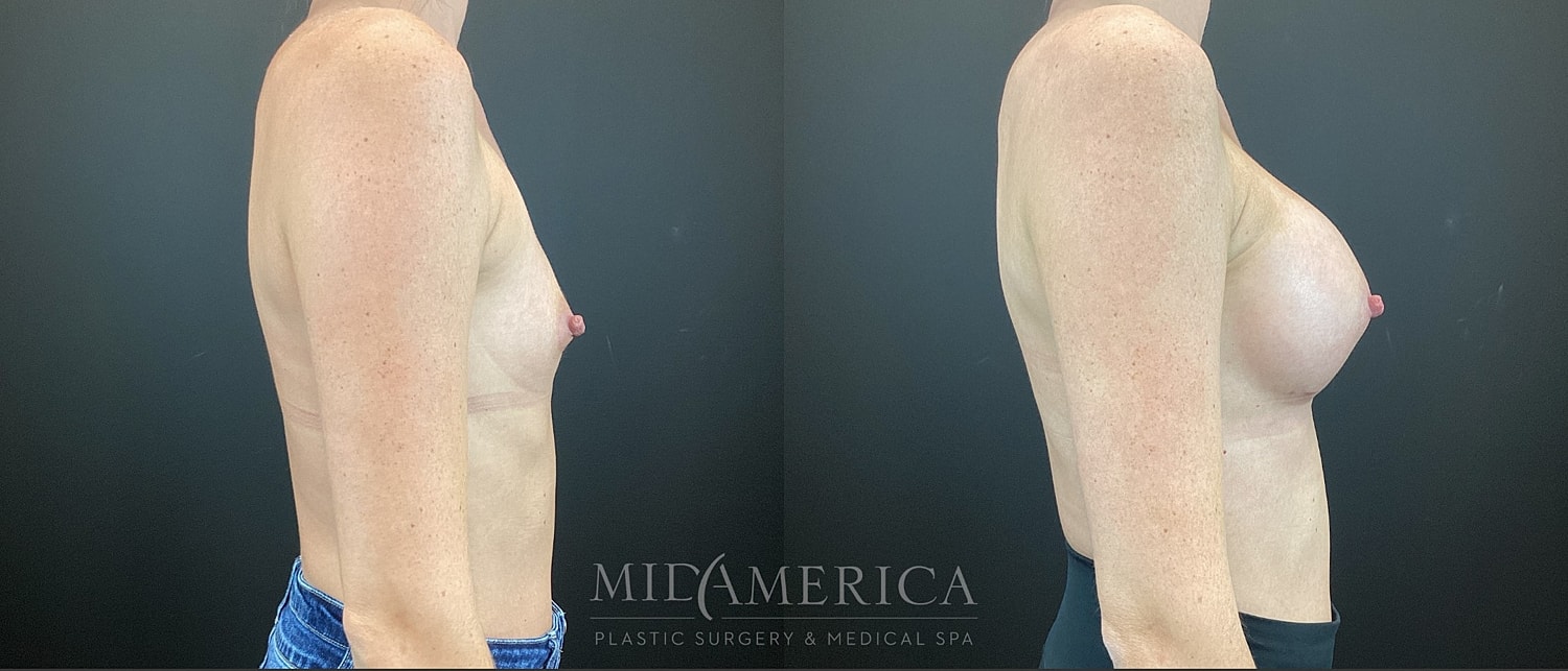 Breast Augmentation Before & After
