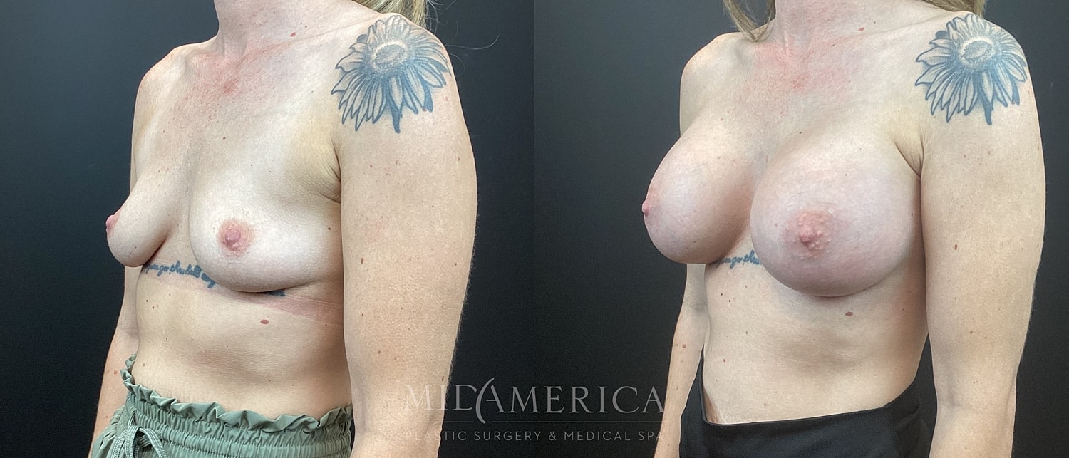 Breast Augmentation Before & After