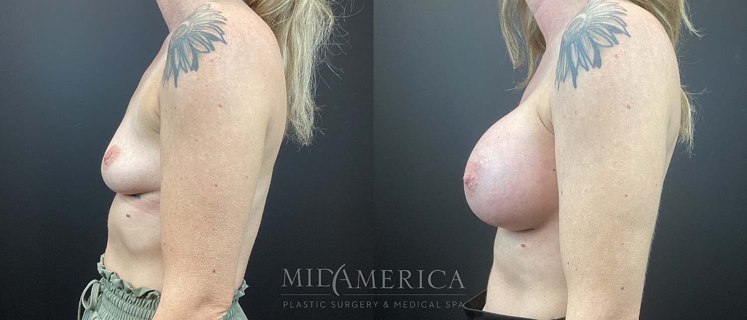 Breast Augmentation Before & After