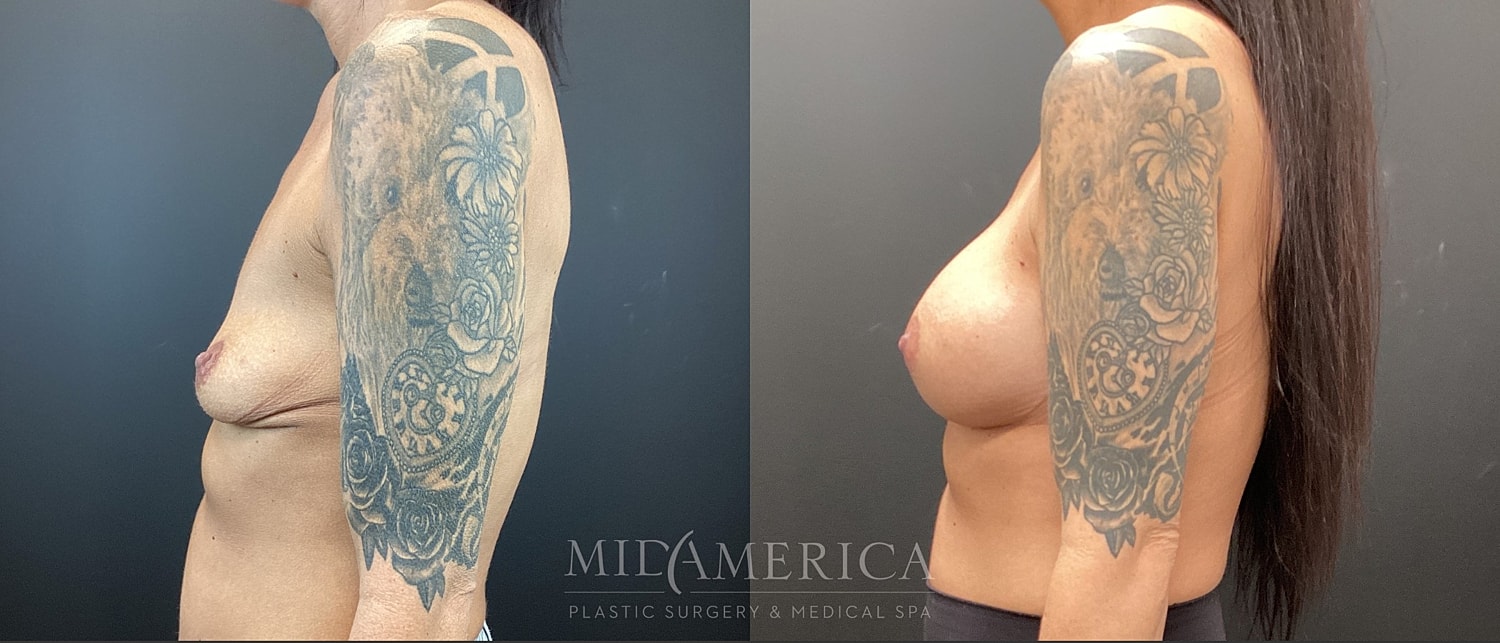Breast Augmentation Before & After
