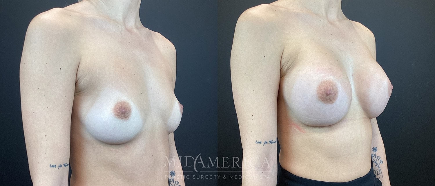 Breast Augmentation Before & After