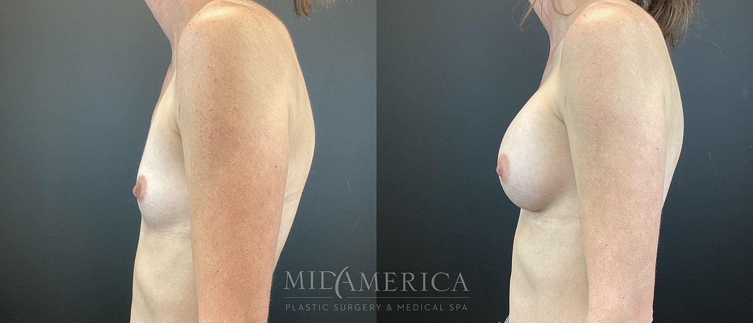 Breast Augmentation Before & After