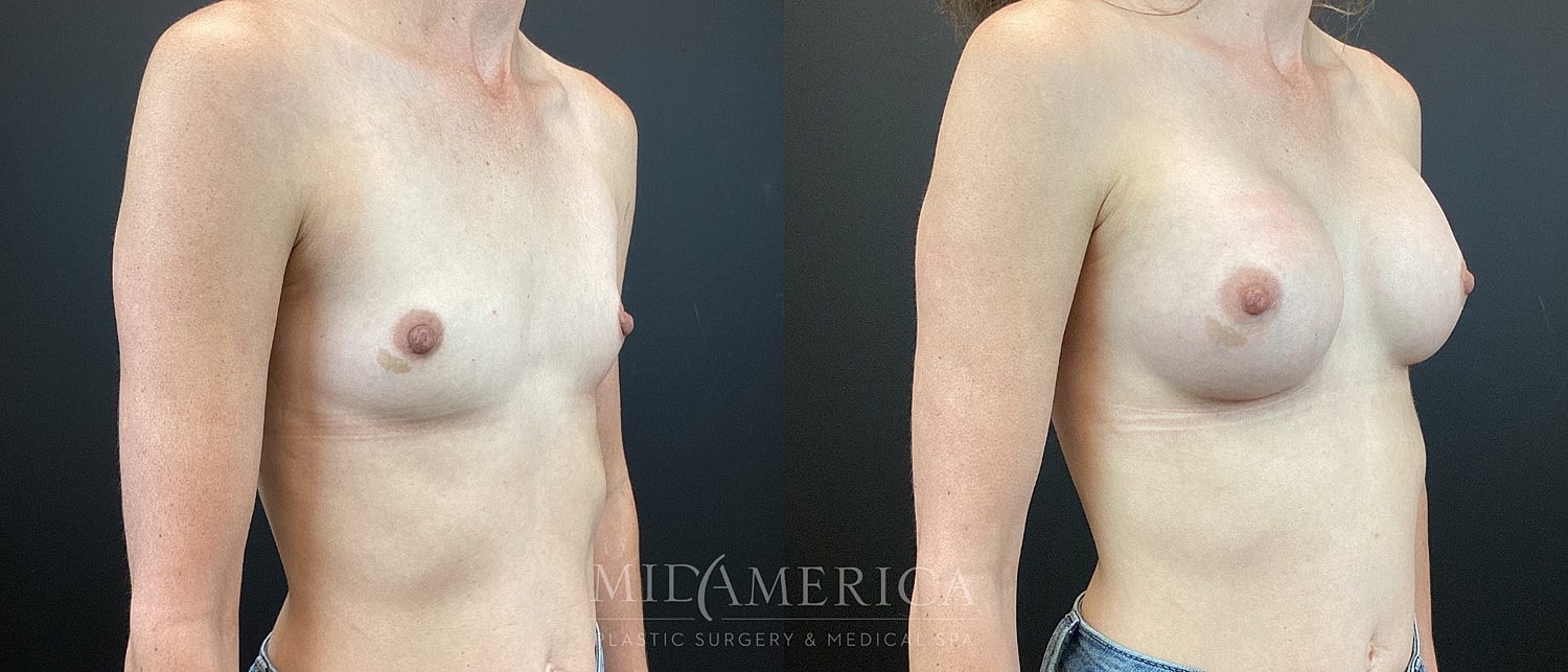 Breast Augmentation Before & After