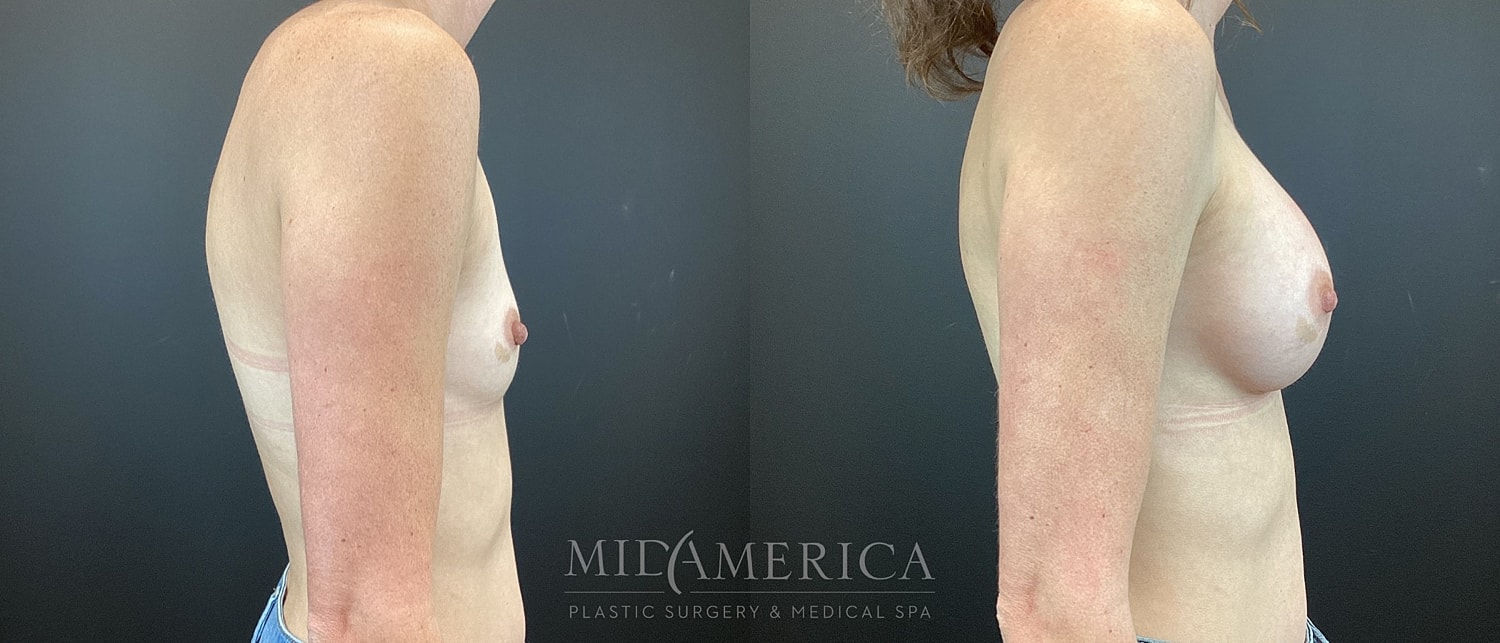 Breast Augmentation Before & After