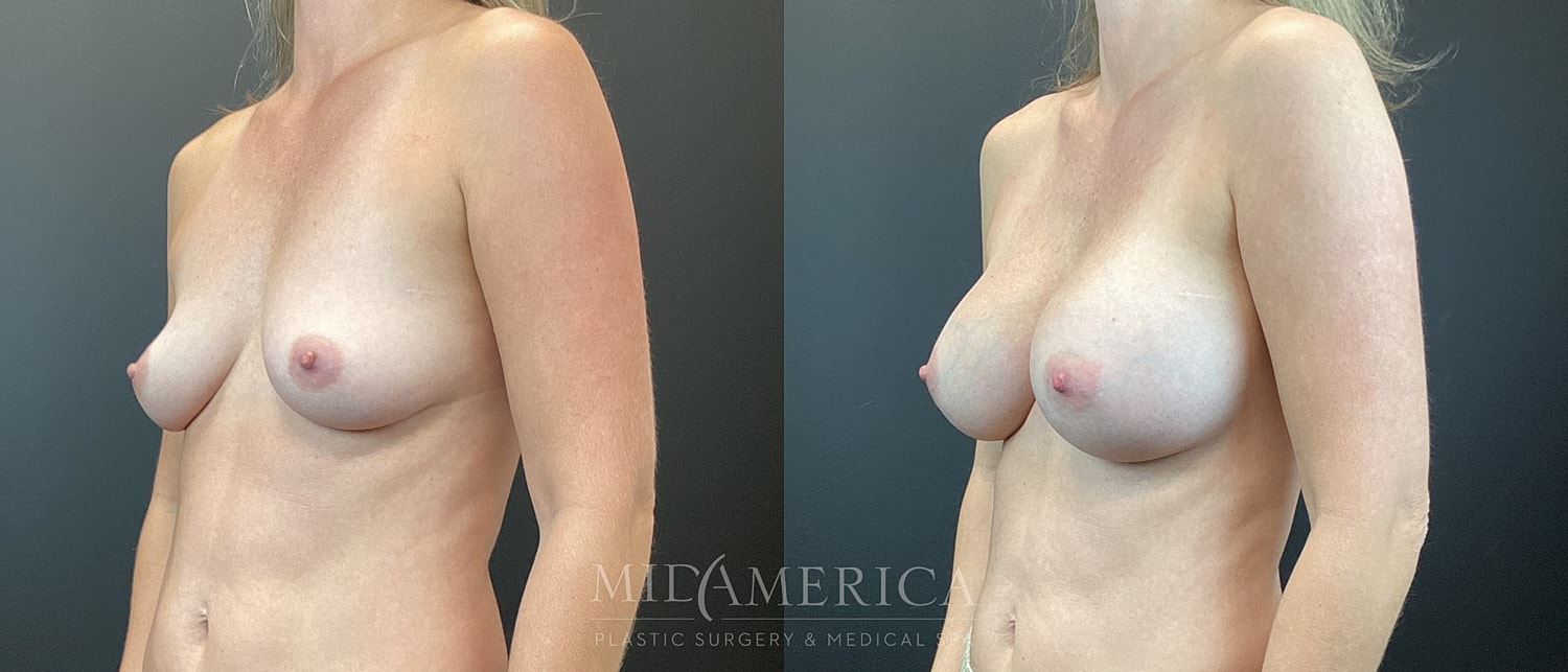 Breast Augmentation Before & After