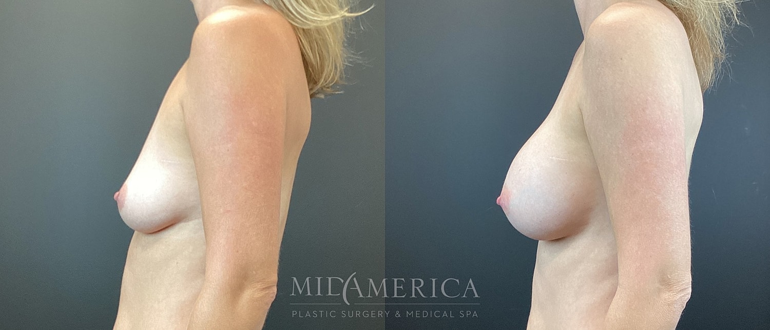 Breast Augmentation Before & After