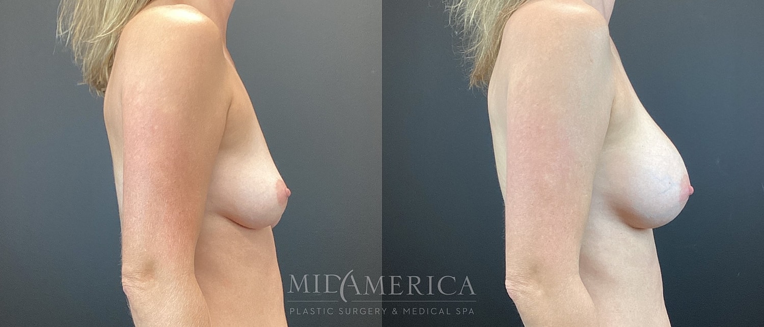 Breast Augmentation Before & After