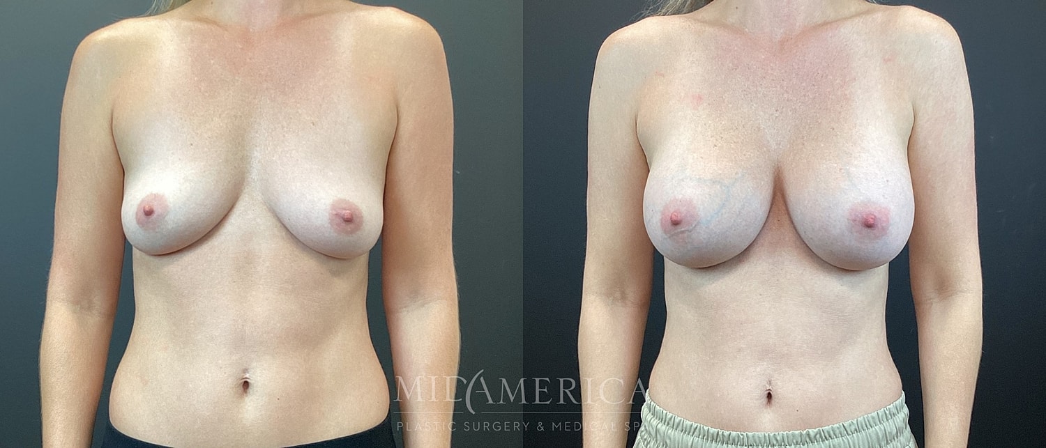 Breast Augmentation Before & After