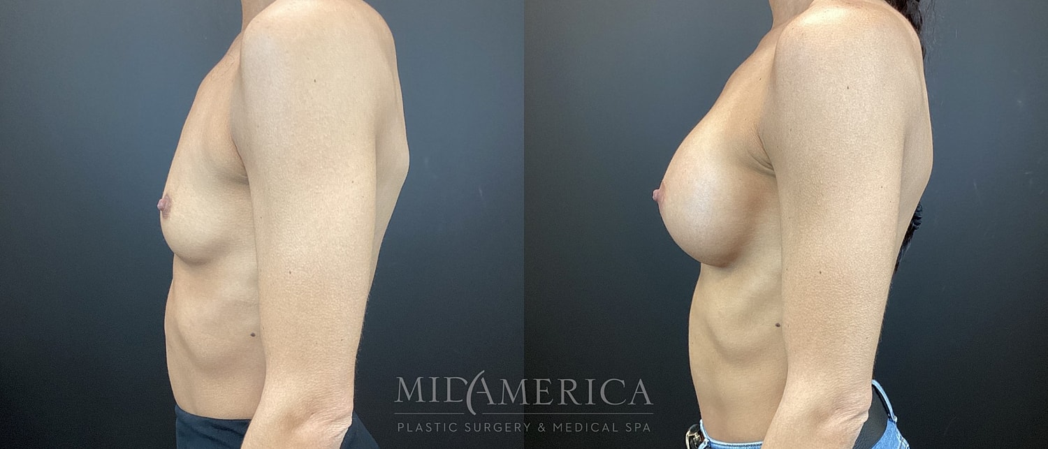 Breast Augmentation Before & After