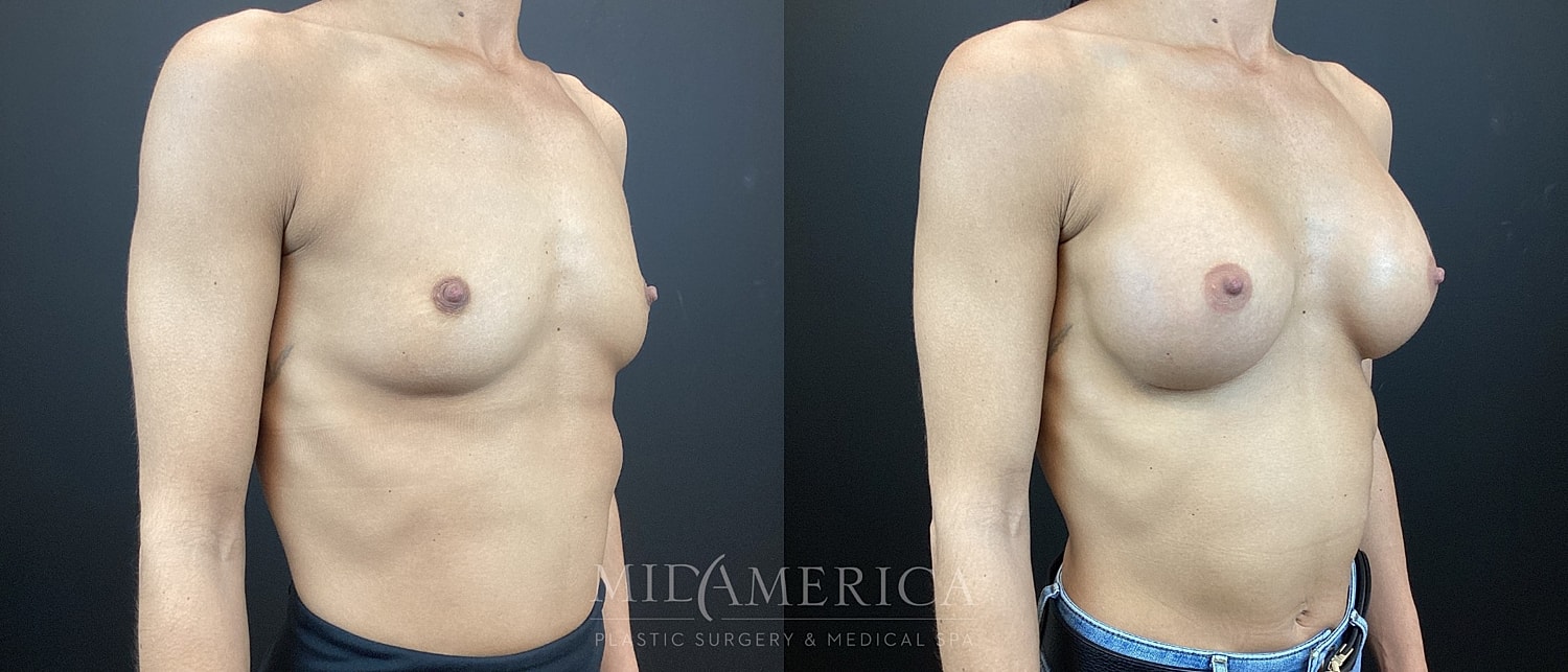 Breast Augmentation Before & After