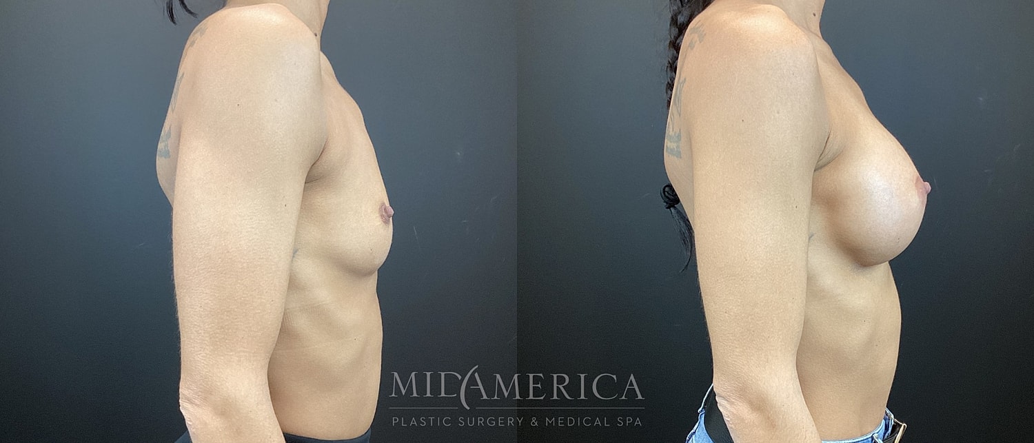 Breast Augmentation Before & After