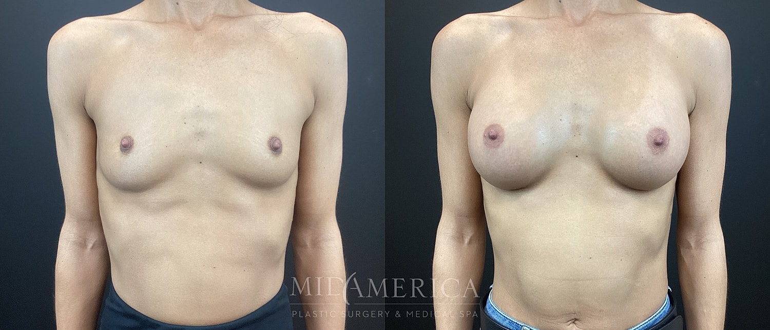 Breast Augmentation Before & After