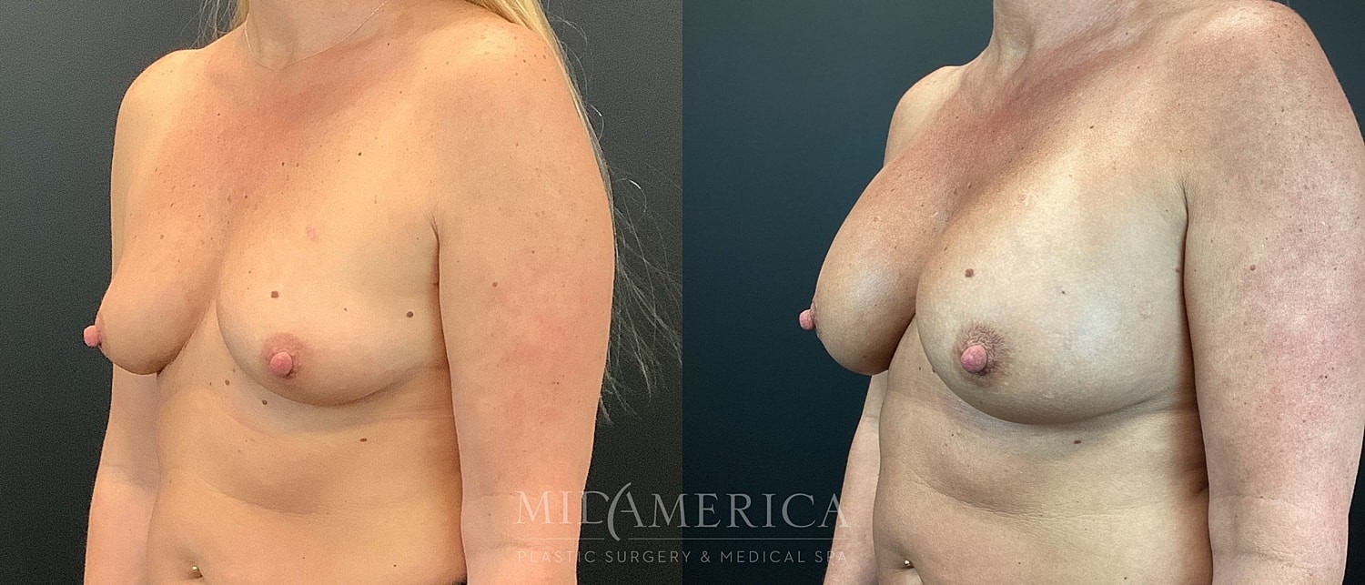 Before and after breast enhancement comparison.