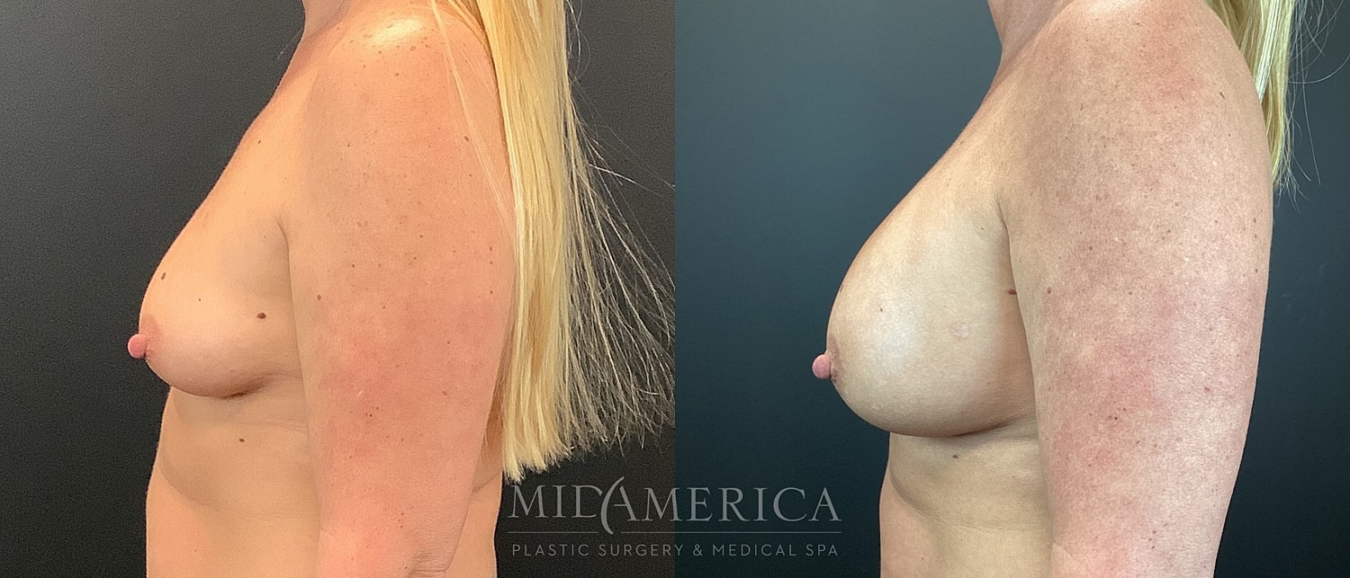 Before and after breast enhancement comparison side view.