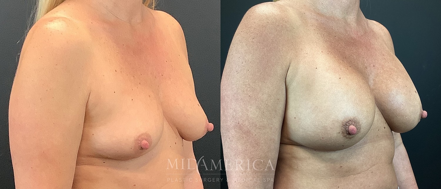 Before and after breast surgery comparison.
