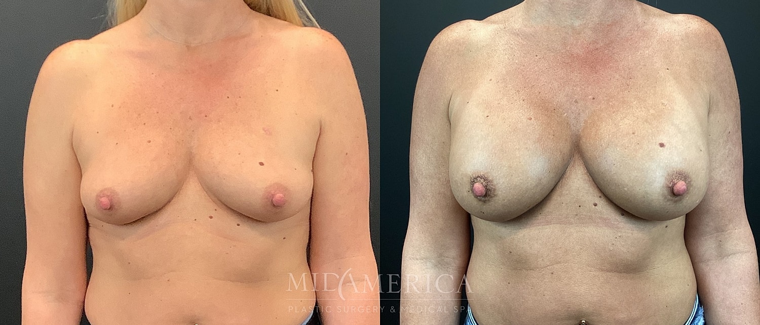 Before and after breast enhancement results.
