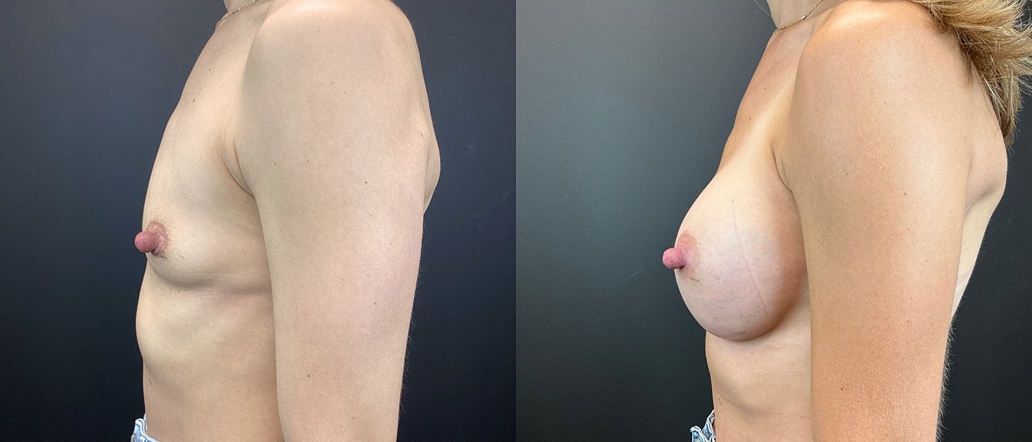 Breast Augmentation Before & After