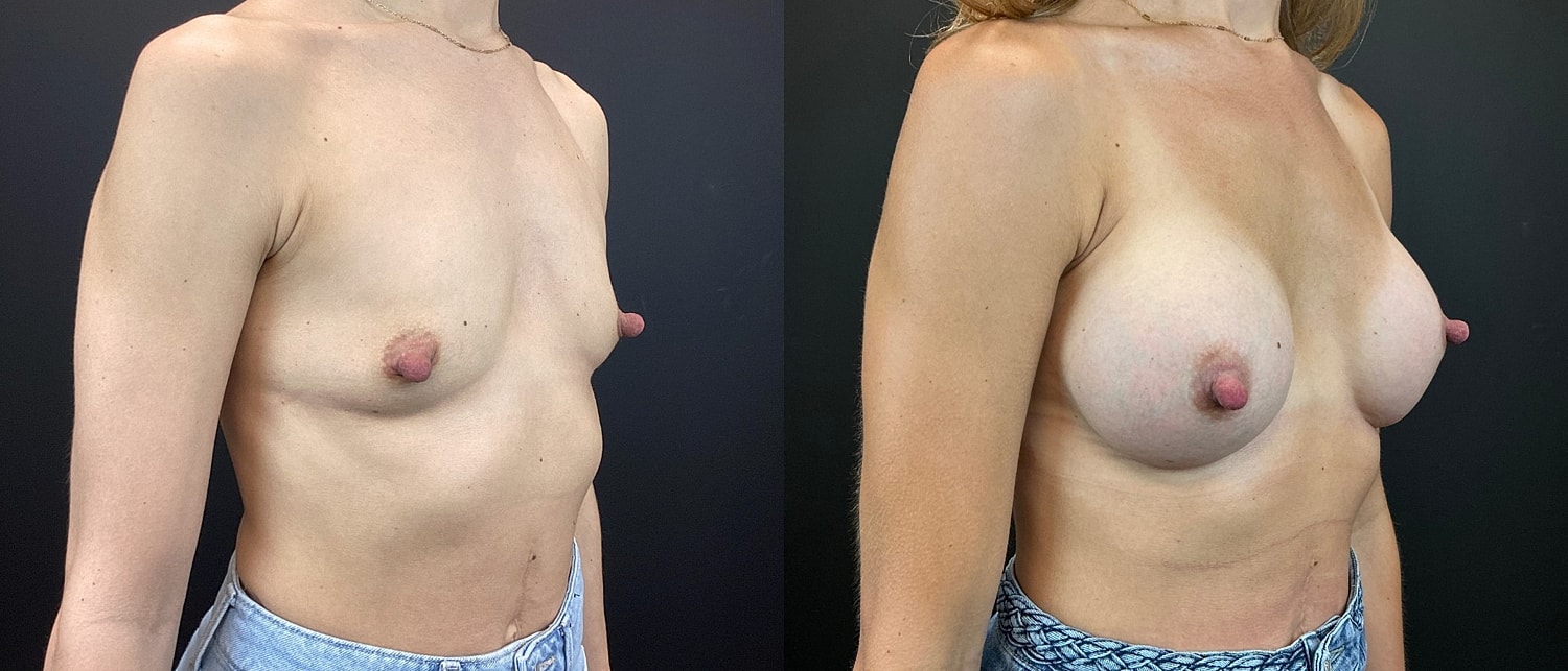 Breast Augmentation Before & After