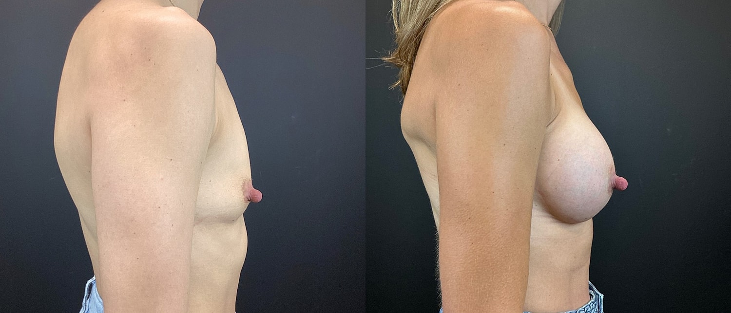 Breast Augmentation Before & After