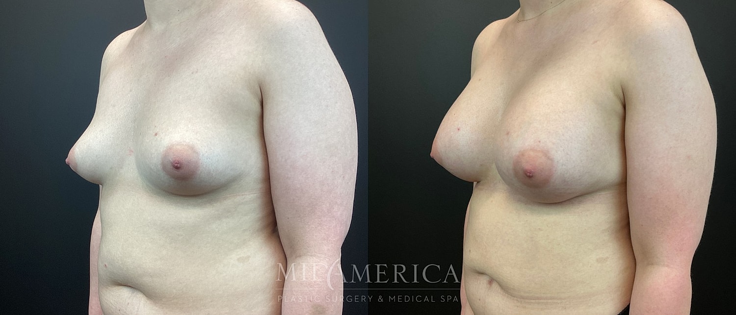 Breast Augmentation Before & After