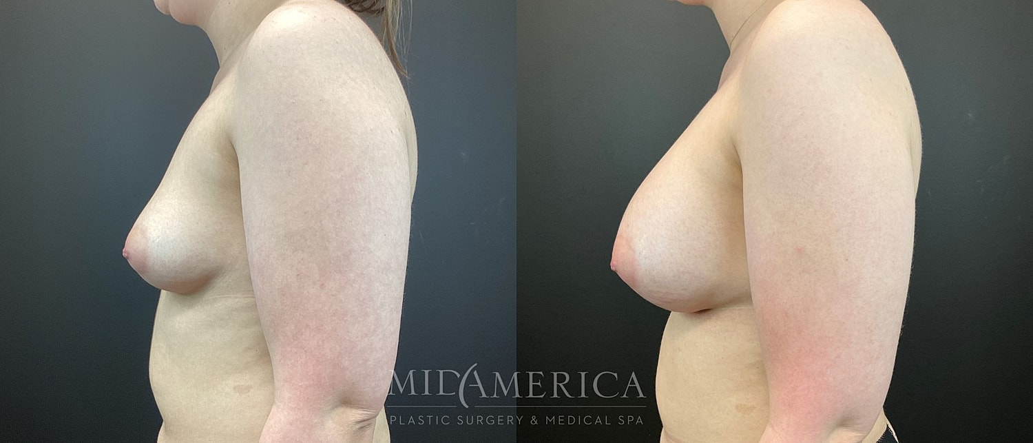Breast Augmentation Before & After