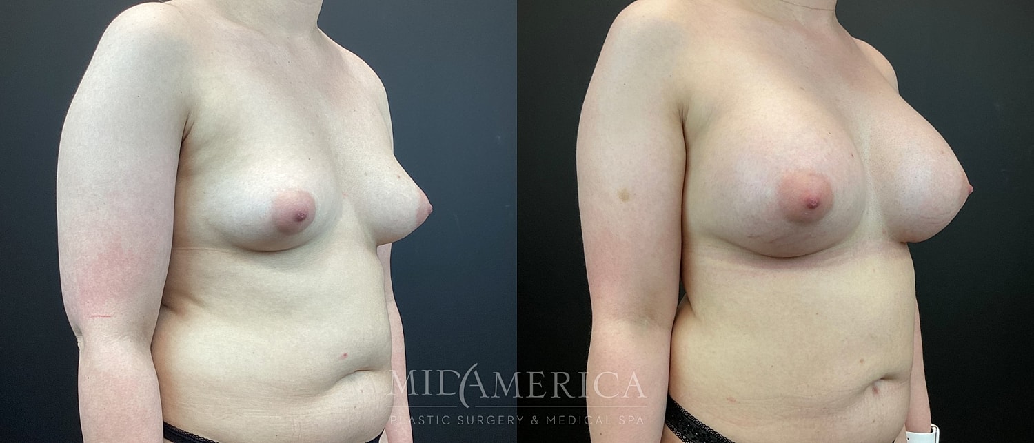 Breast Augmentation Before & After