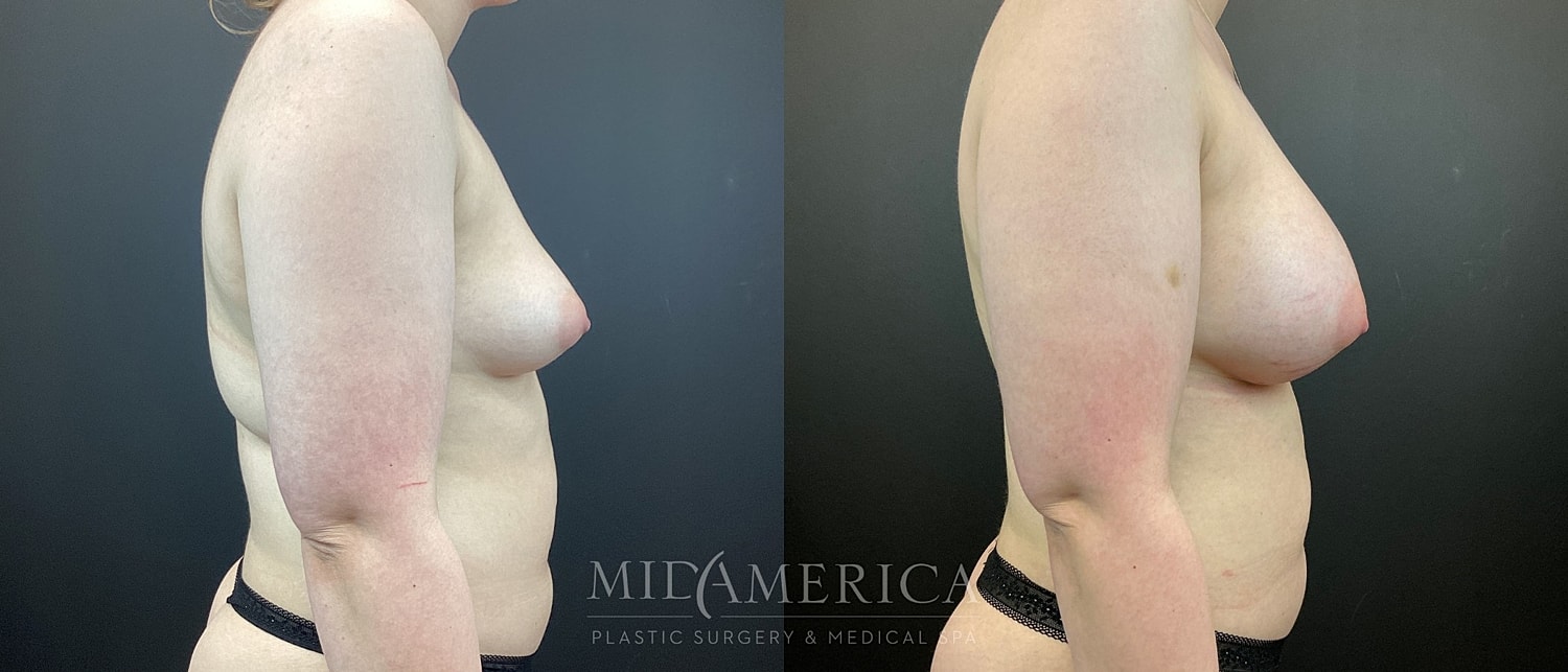 Breast Augmentation Before & After