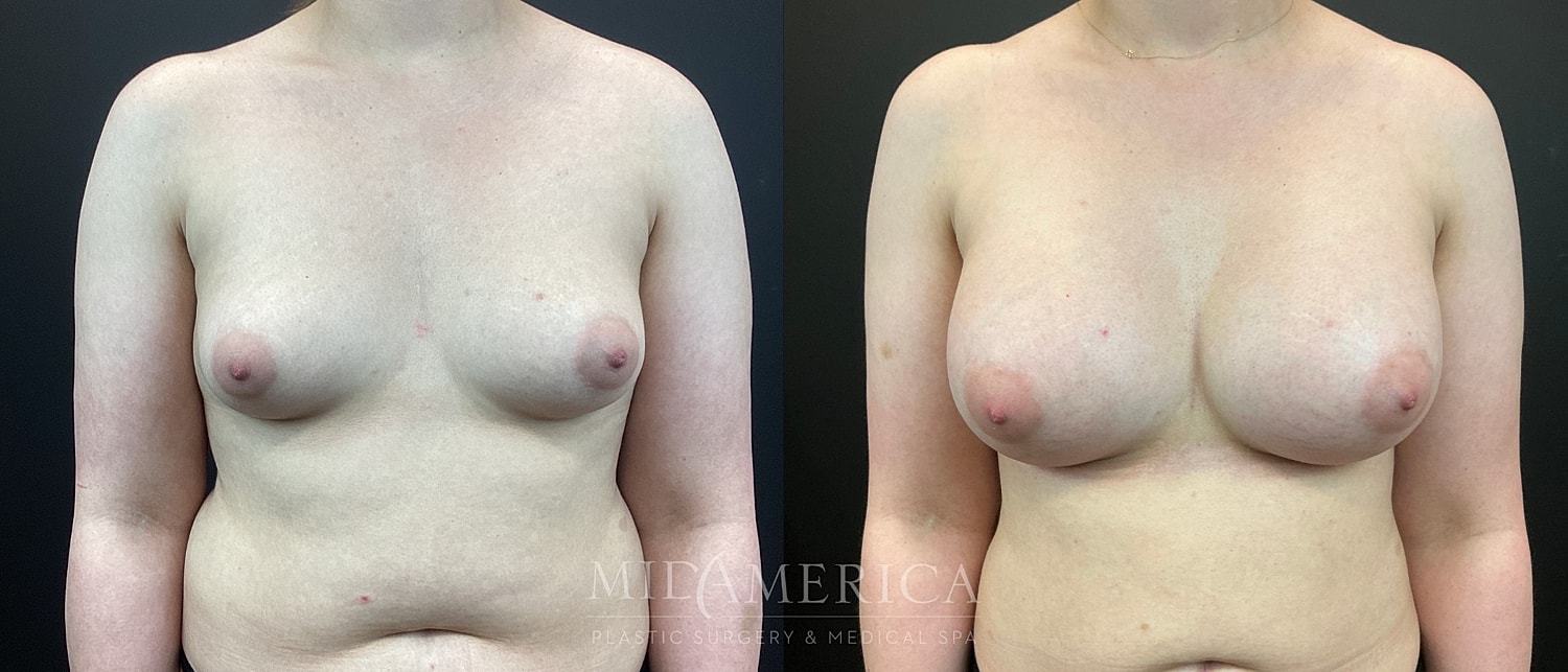Breast Augmentation Before & After