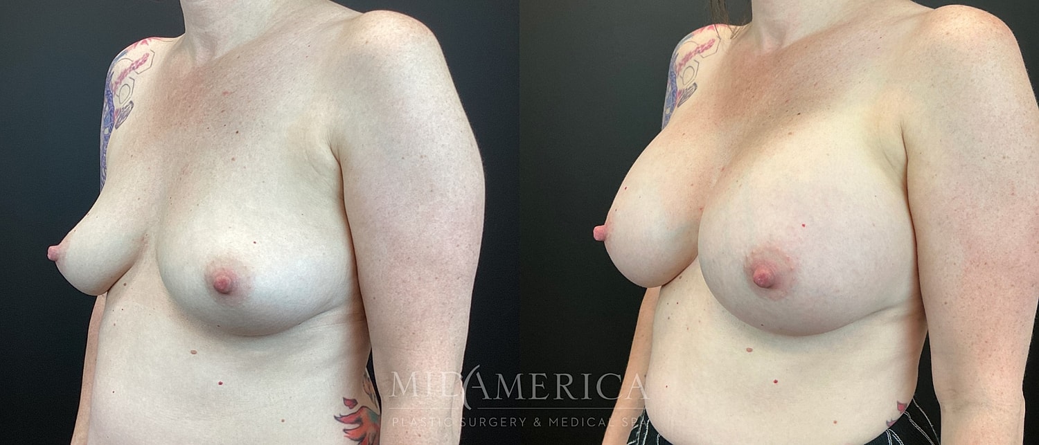 Breast Augmentation Before & After