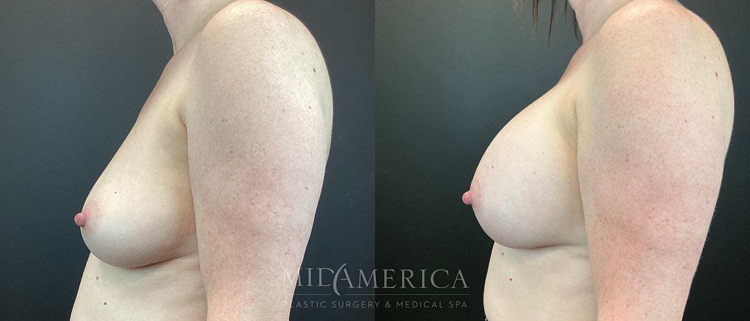 Breast Augmentation Before & After