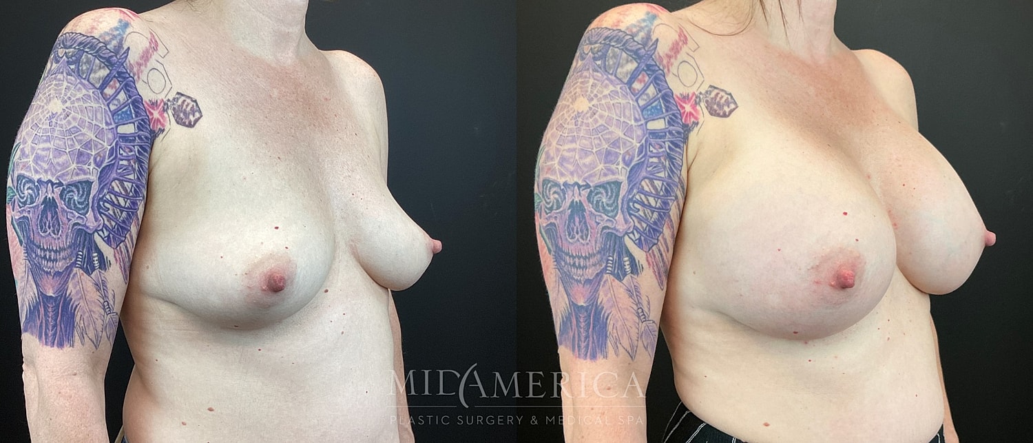 Breast Augmentation Before & After