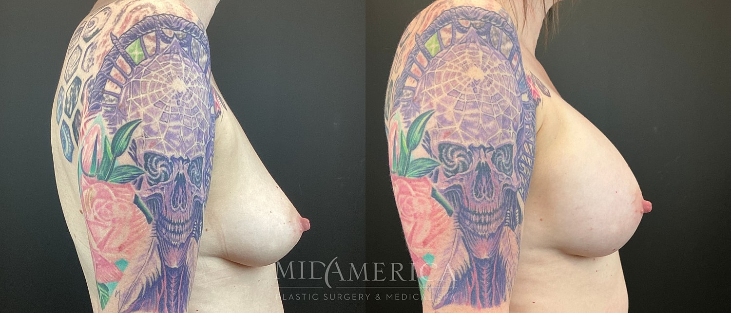 Breast Augmentation Before & After