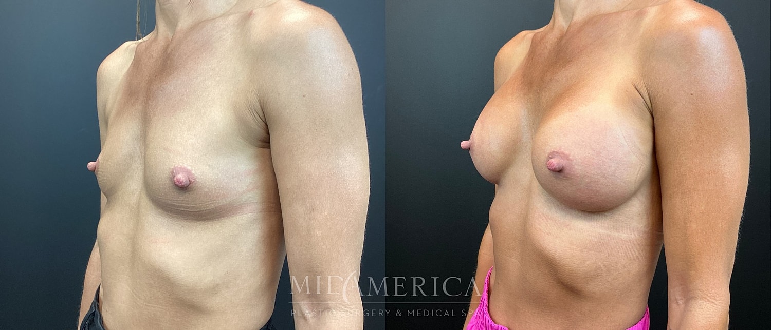 Breast Augmentation Before & After