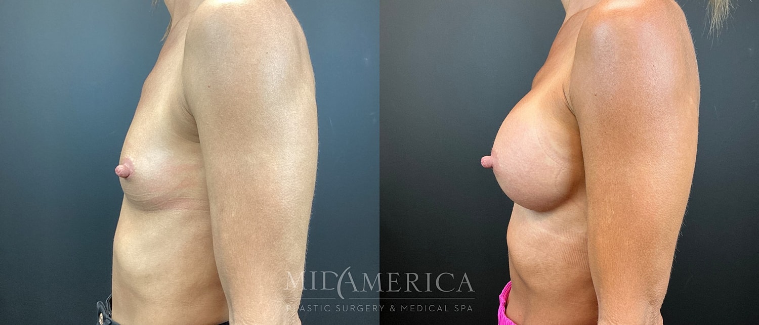 Breast Augmentation Before & After