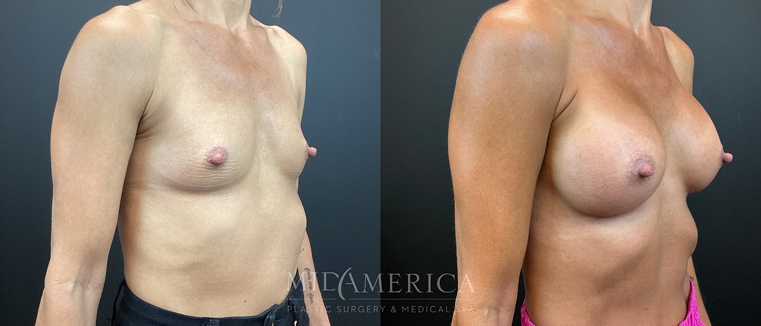 Breast Augmentation Before & After