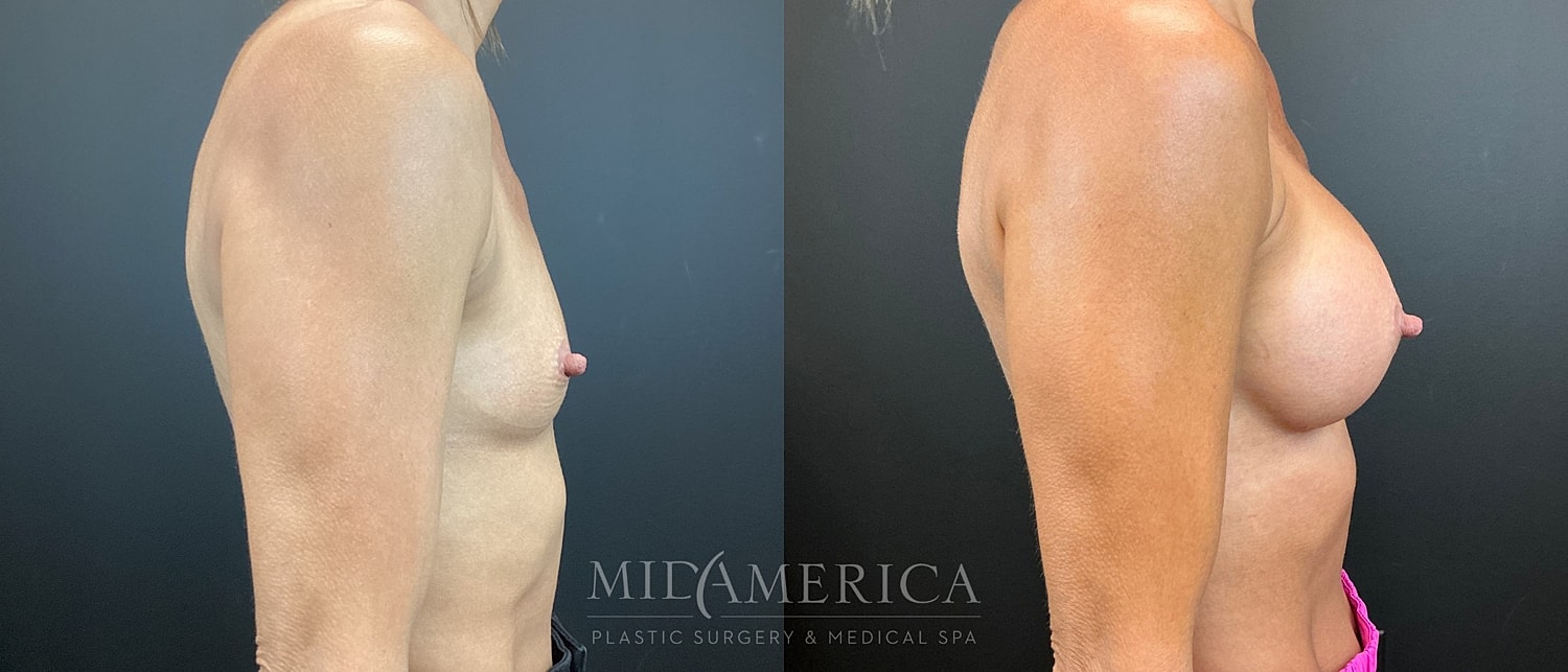 Breast Augmentation Before & After