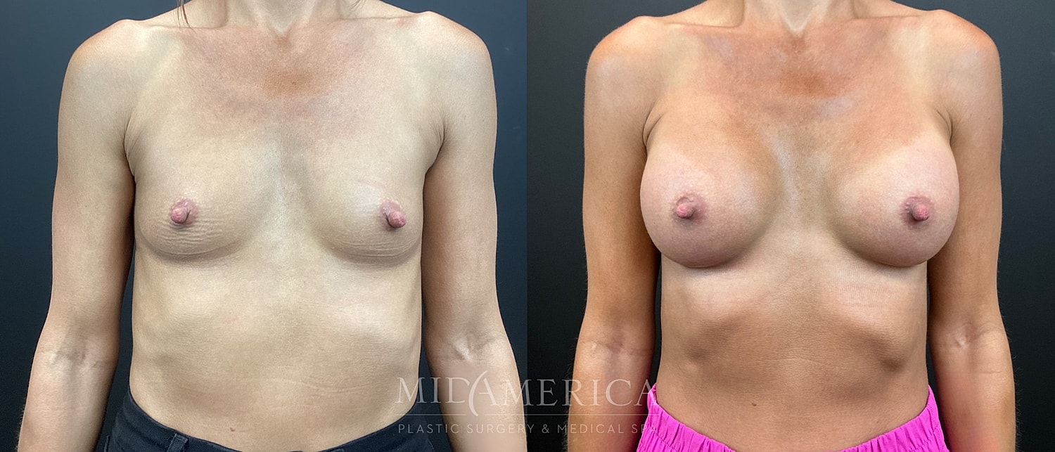 Breast Augmentation Before & After