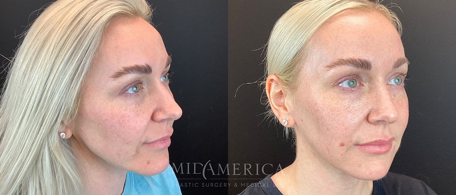 Dermal Fillers Before & After