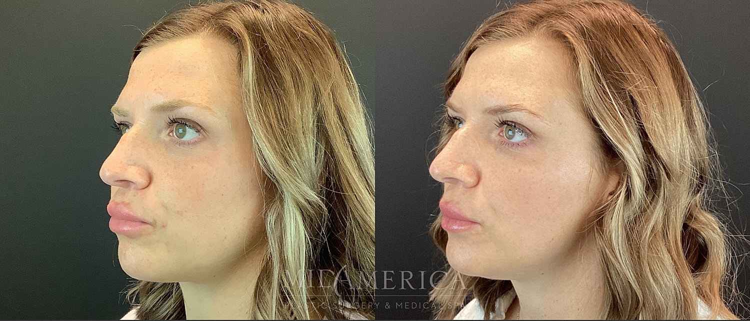 Dermal Fillers Before & After