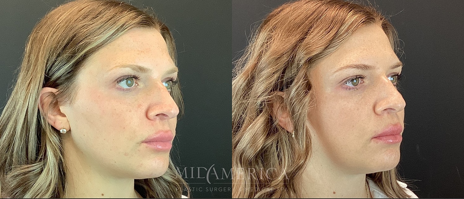 Dermal Fillers Before & After