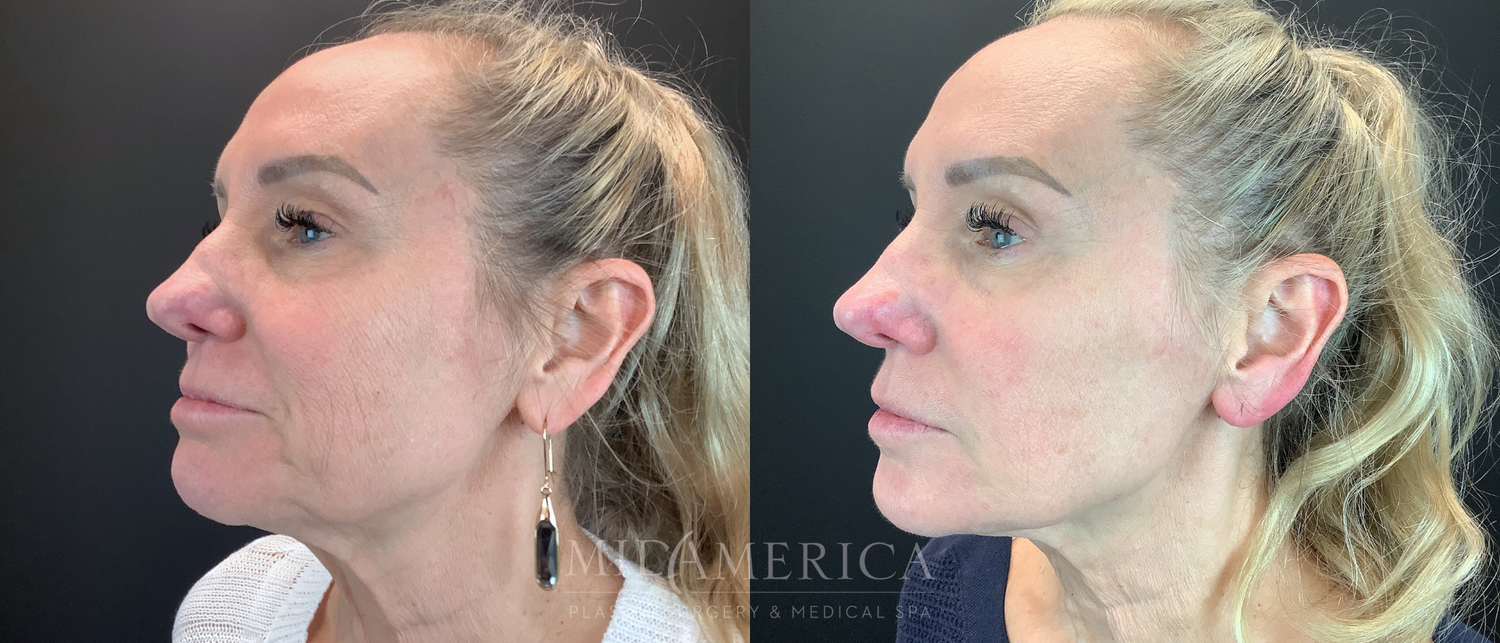 Dermal Fillers Before & After