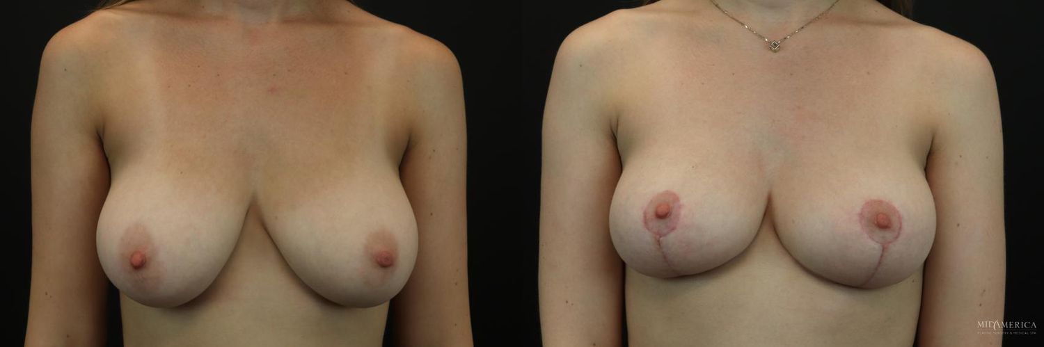 Breast Reduction Before & After