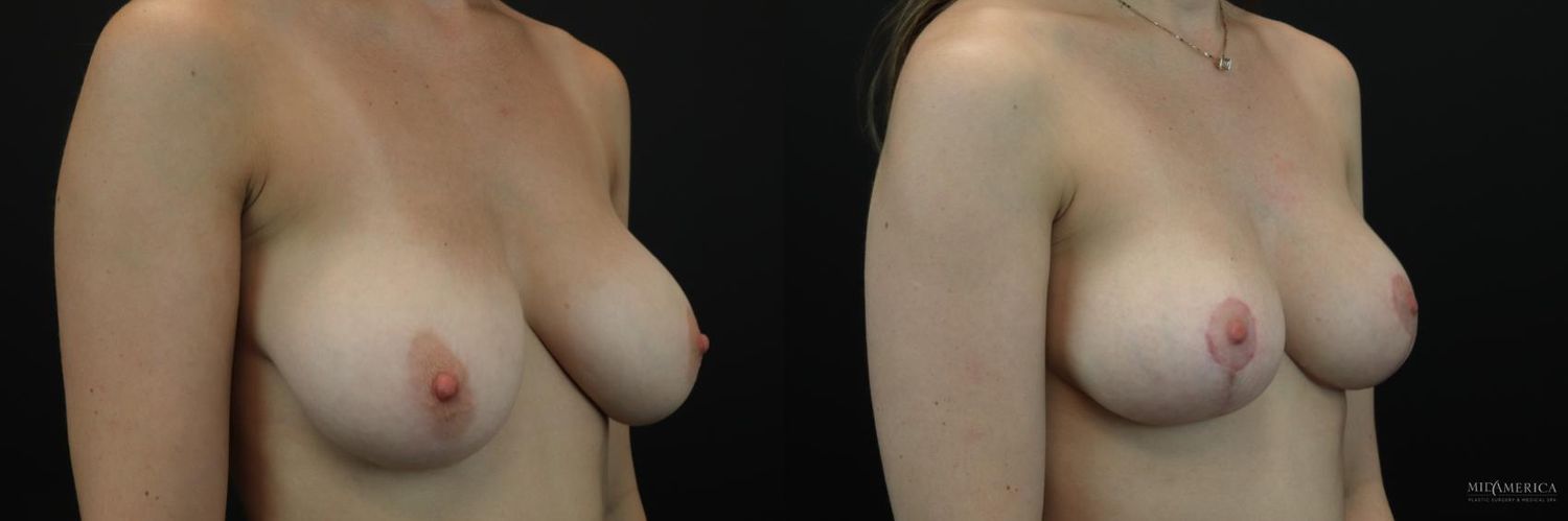 Breast Reduction Before & After