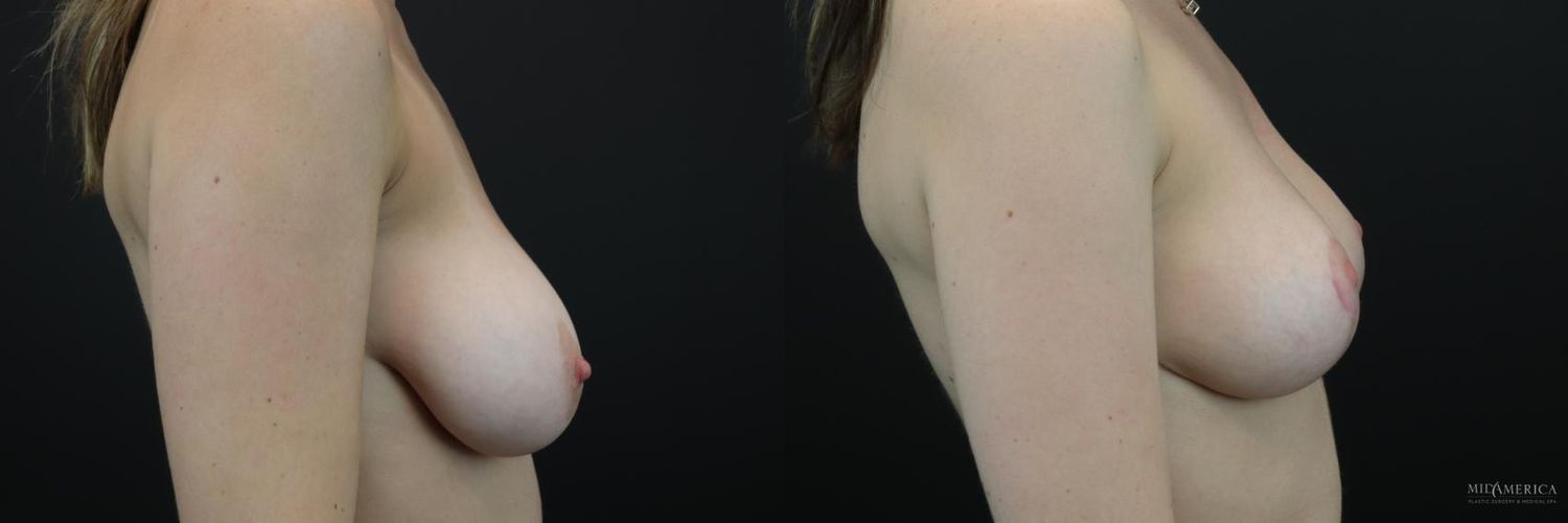 Breast Reduction Before & After