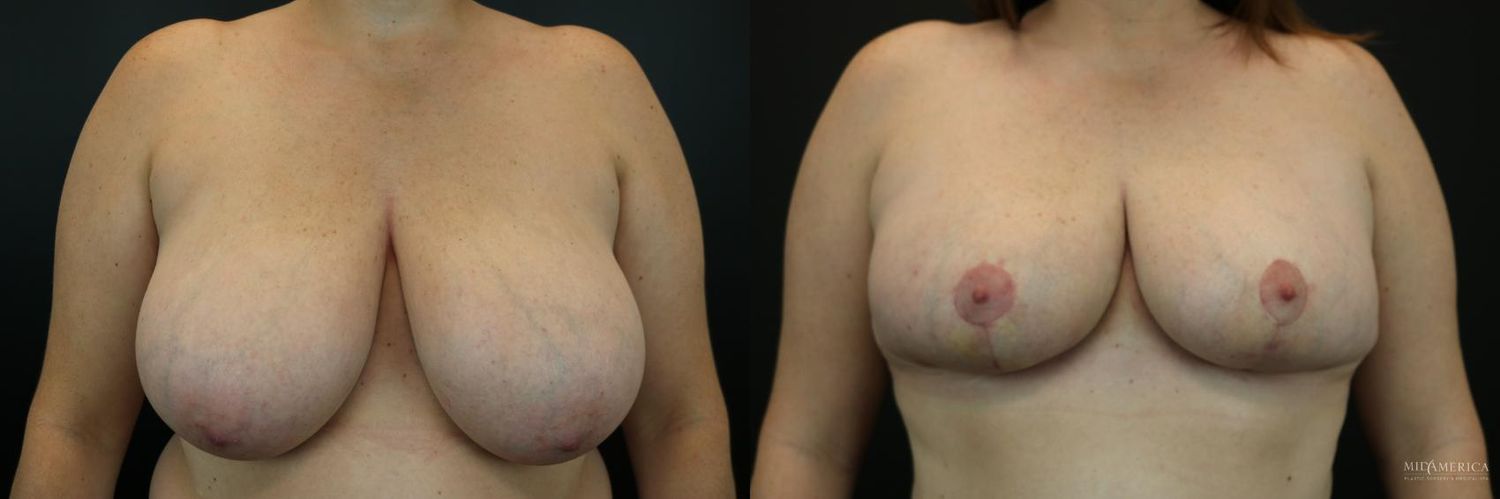 Breast Reduction Before & After