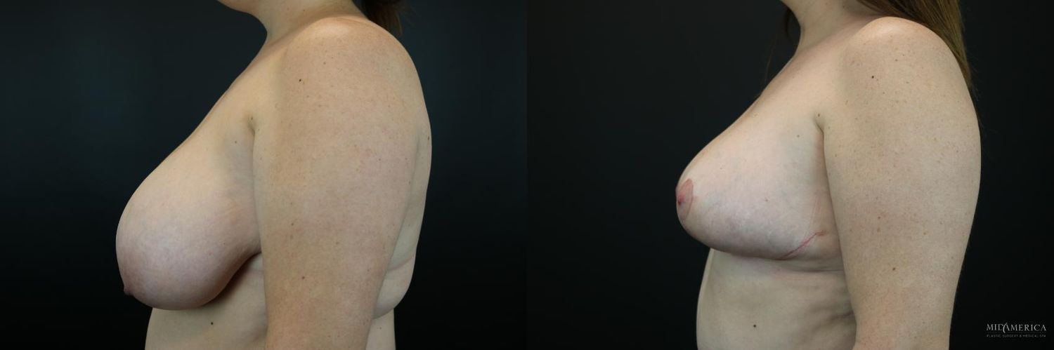 Breast Reduction Before & After