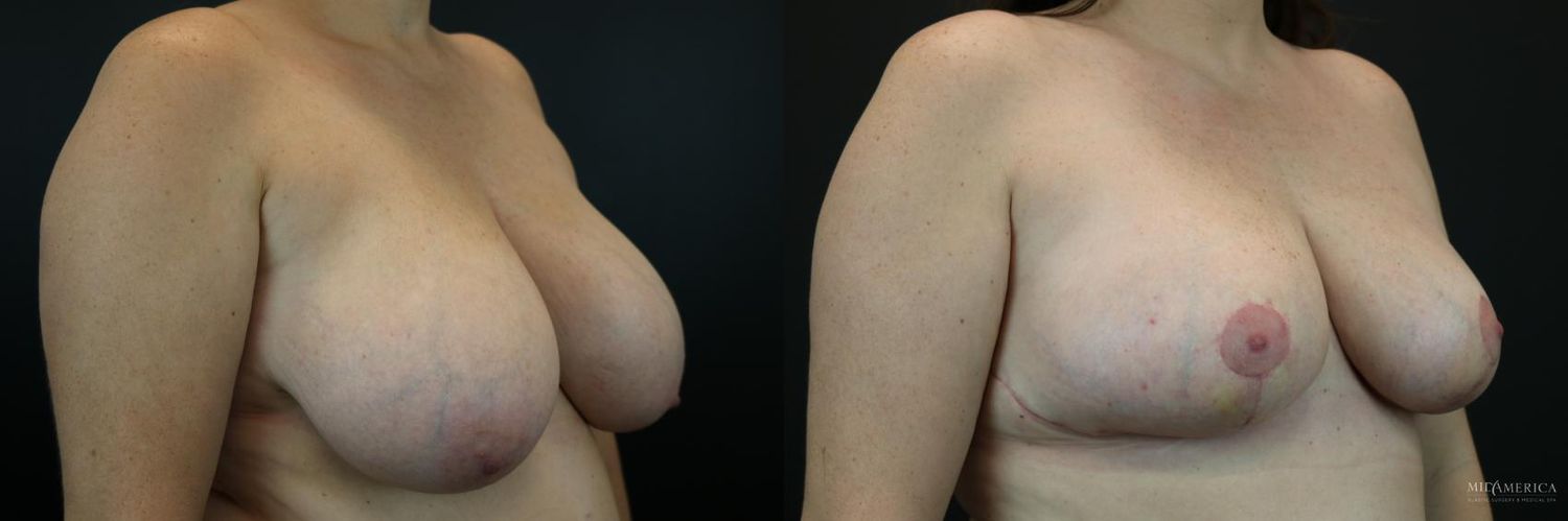 Breast Reduction Before & After
