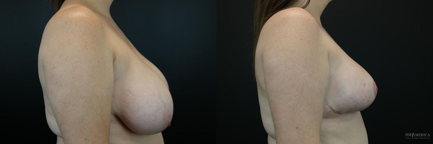 Breast Reduction Before & After